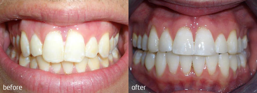 Cosmetic contouring clearance