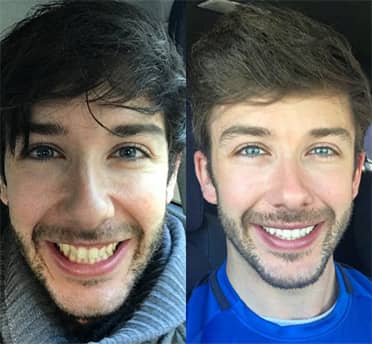 Invisalign Braces - Before and After