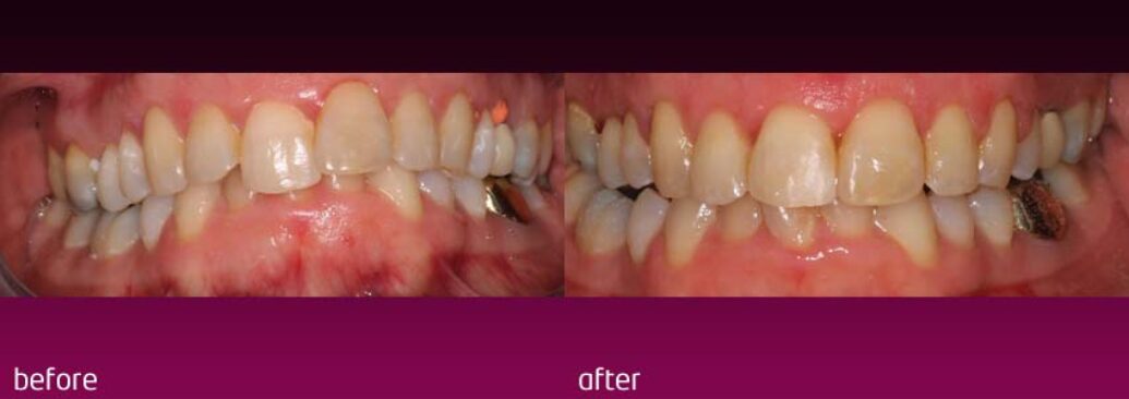 6monthsmile12
