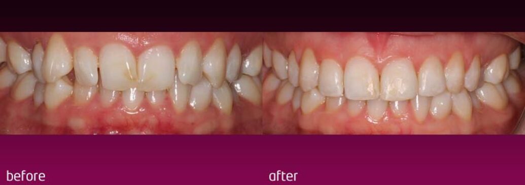 6monthsmile13