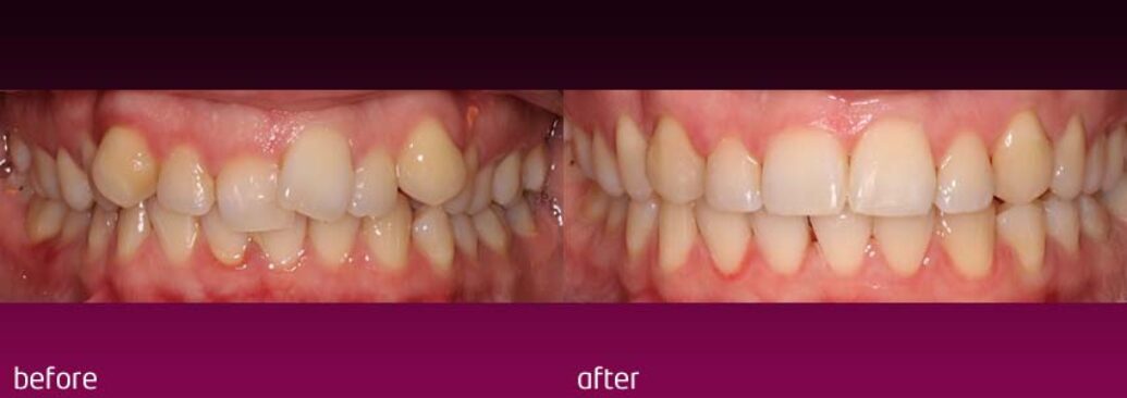 6monthsmile14