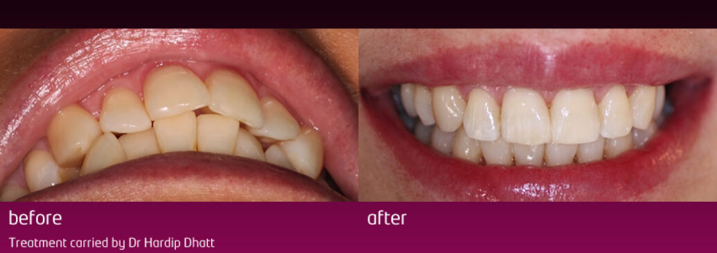 6monthsmile17