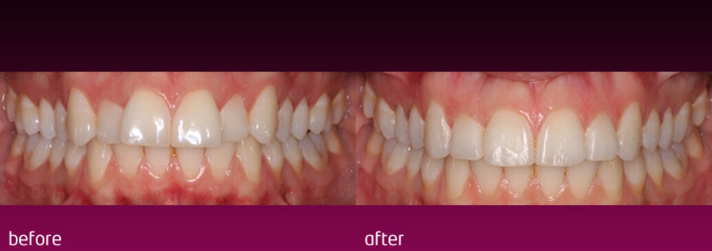 6monthsmile2