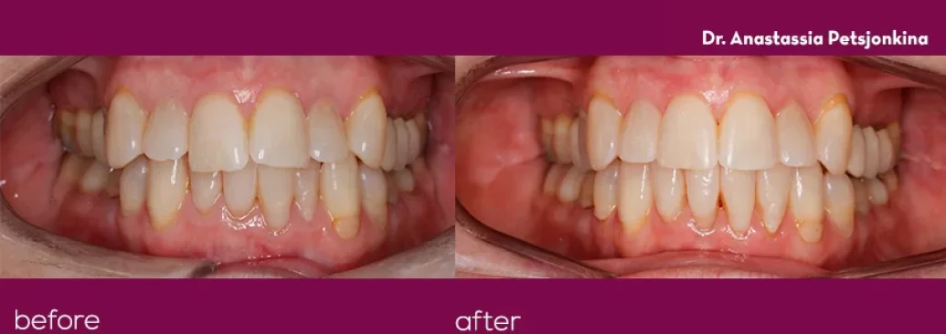 Invisalign-5-1 (1)