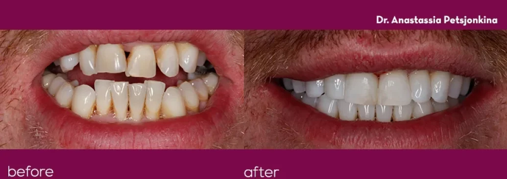 Invisalign-Cosmetic-bonding-3-1