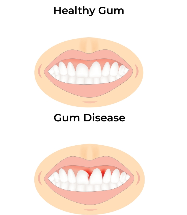 Healthy gums vs gum disease