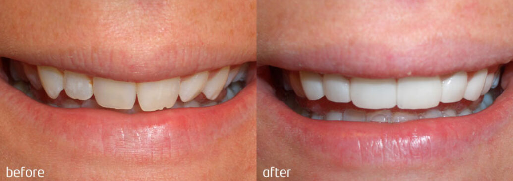 veneers1