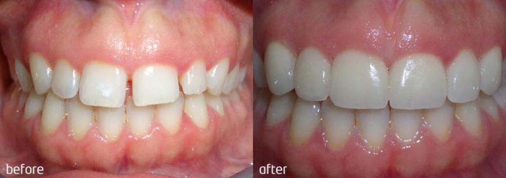 veneers2