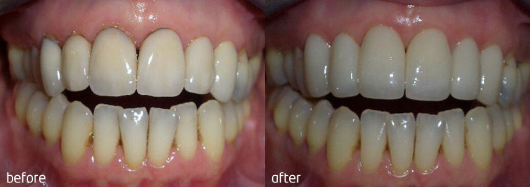 veneers3