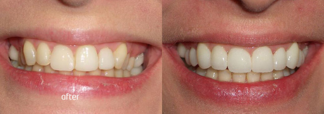 veneers4