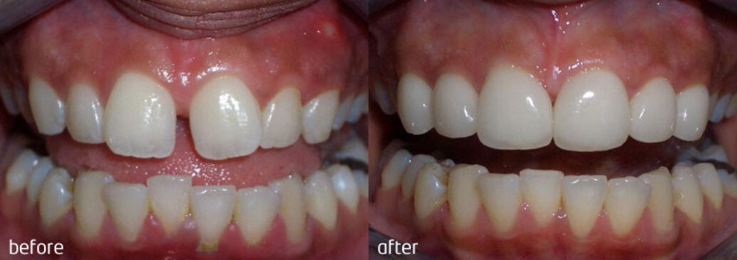 veneers5