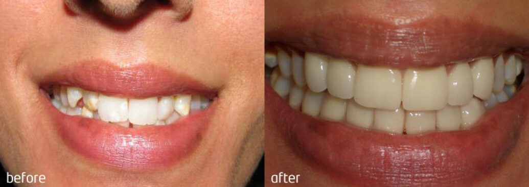 veneers8