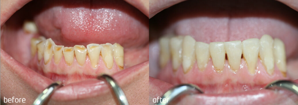 white-fillings2