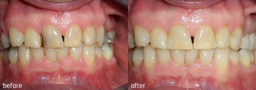 white_fillings1