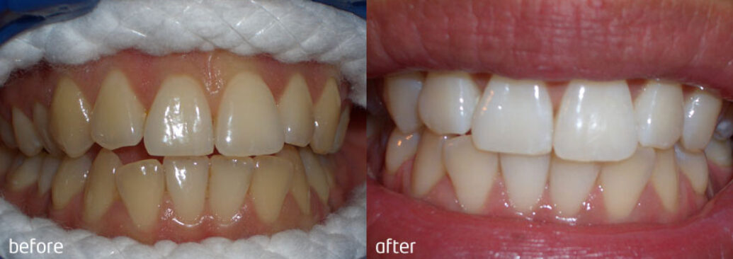 whitening1