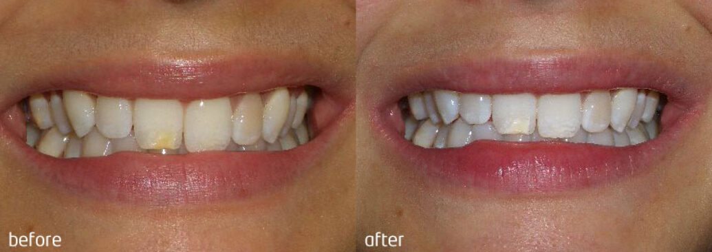 whitening2