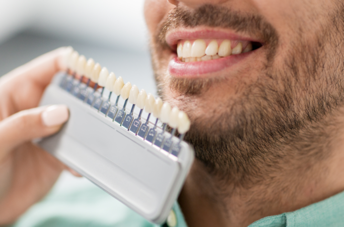 Close up of the lower third of a man's face (late 30s). He is undergoing veneers treatment