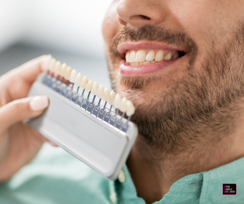 Close up of the lower third of a man's face (late 30s). He is undergoing veneers treatment